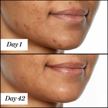 Load image into Gallery viewer, U.F.O. Salicylic Acid BHA Acne Treatment Face Oil