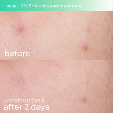 Load image into Gallery viewer, Acne+ 2% BHA and Azelaic Acid Acne Spot Treatment