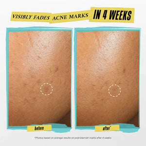 Truly Targeted Acne-Clearing Salicylic Acid Pimple Patch