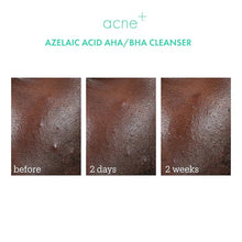 Load image into Gallery viewer, Acne+ 2% BHA + Azelaic Acid + Niacinamide + AHA Cleanser